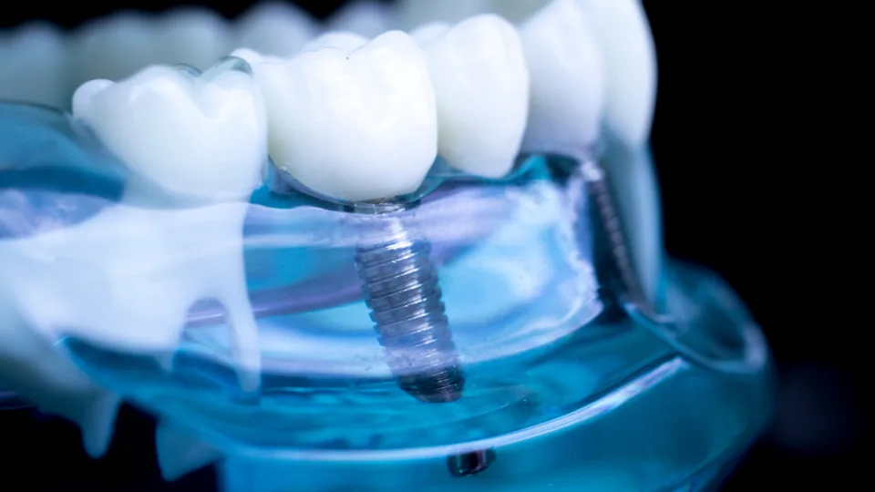 Ilustración de un implante dental que sustituye la raíz de un diente