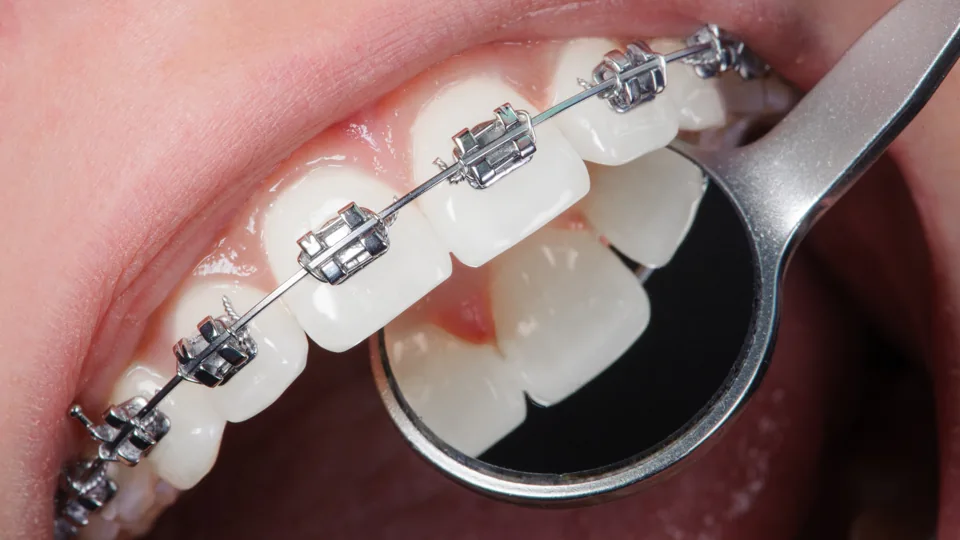 Atención de ortodoncia con brackets